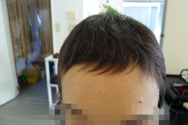 抗がん剤治療後 前髪の伸び方が遅いのですが 伊那市 松本市で医療用ウィッグの作製 自毛の相談が出来るヘアサロン
